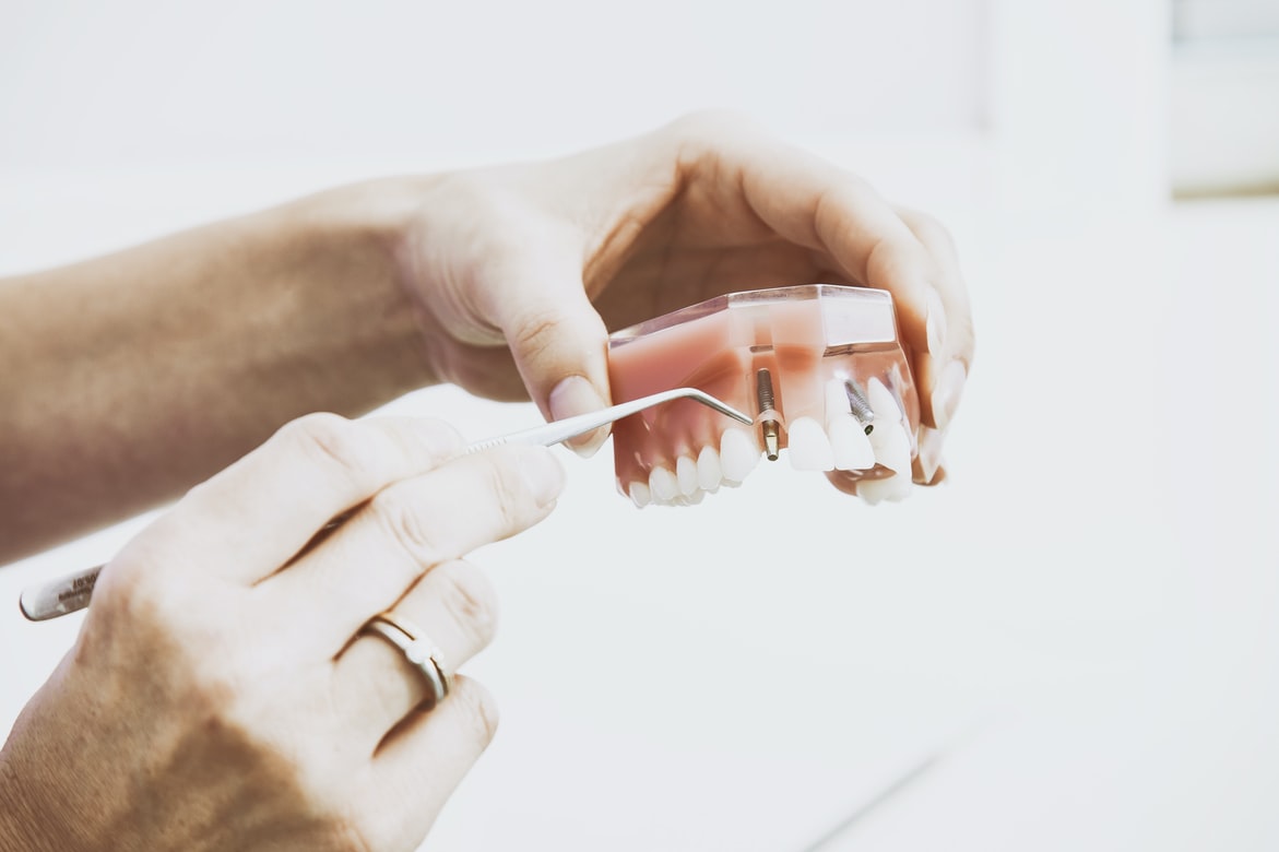 What Are Dental Implants? What Are Dental Implants?